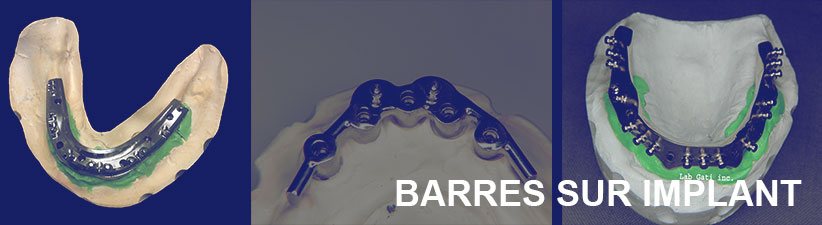 Barres sur implant | Laboratoire dentaire Gati